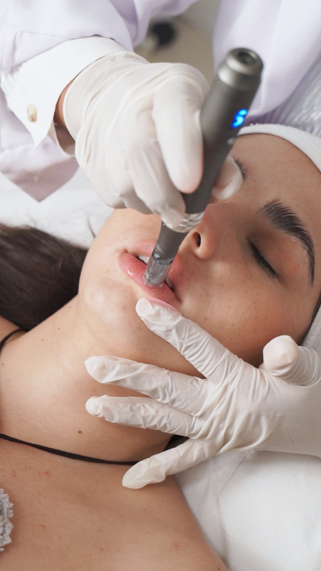 Microneedling (dermapen)